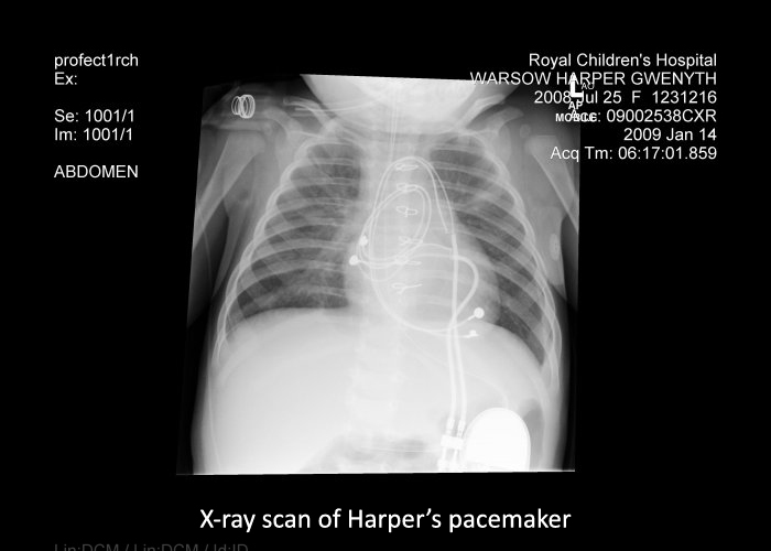 Harper’s Heart Condition Raises Thousands in 30 days